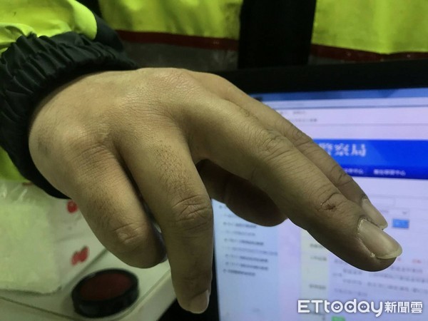 警察壓制過程手部不慎擦挫傷。