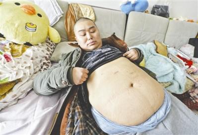 2017年2月3日，胖哥張濤（化名）展示自己手術(shù)的刀口，基本上沒(méi)有痕跡。